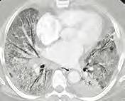 EGFR-mediated pneumocytes which is inhibited CT: ground
