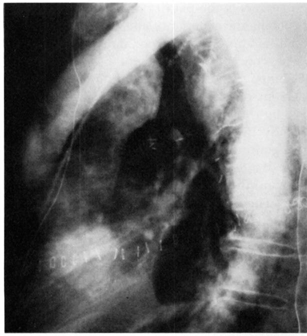 The graft was unclipped, unraveled, and attached to the descending thoracic aorta after declotting. The aneurysm was transected to perform an aneurysmorrhaphy.