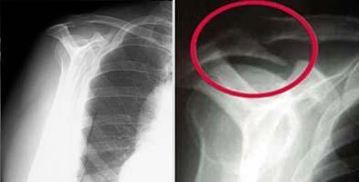 X-rays. Becauses x-rays do not show the soft tissues of your shoulder like the rotator cuff, plain x-rays of a shoulder with rotator cuff pain are usually normal or may show a small bone spur.