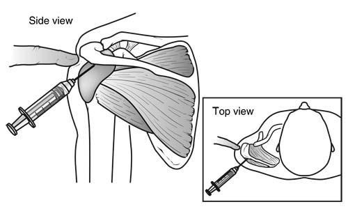 the inner lining of the shoulder and posterior refers to the back of the shoulder). Specific stretching of the posterior capsule can be very effective in relieving pain in the shoulder.