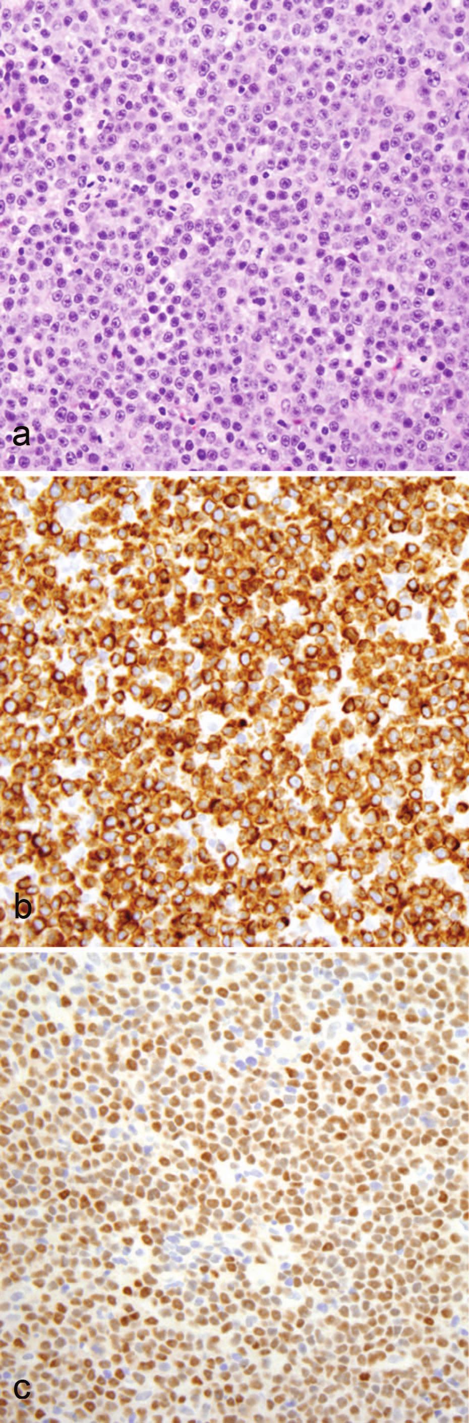 expression of BOB1 favors PMLBCL and expression of cyclin E favors CHL. Although these immunohistochemical stains are not routinely evaluated, most cases of PMLBCL express MAL, CD54, CD95, and TRAF1.