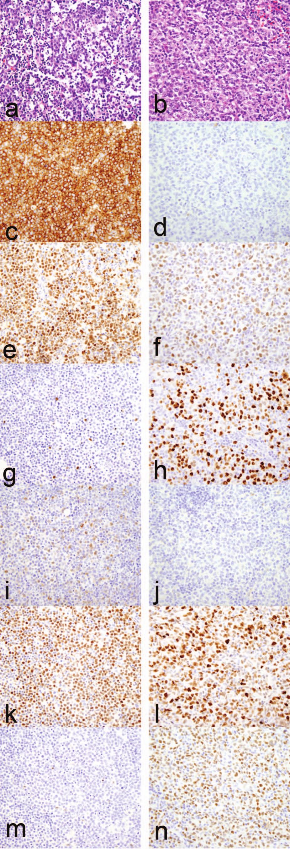 Plasmablastic Lymphoma Plasmablastic lymphoma is an aggressive B-cell neoplasm, which has immunophenotypic features of plasma cells with large cell morphology, and varying degrees of associated, more