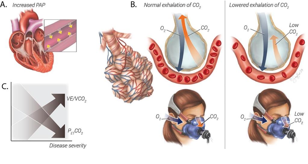 The relationship between pulmonary hypertension pathophysiology and cardiopulmonary exercise testing markers Pinkstaff SO, Burger CD, Daugherty J, Bond S, Arena R.