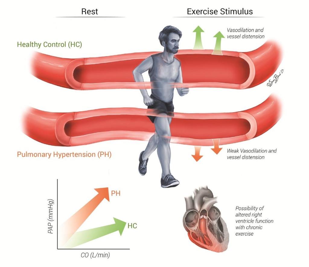 Comparison between normal and abnormal pulmonary arterial vessel response to exercise: implications for cardiac output with an acute exercise stimulus and right ventricular function with chronic