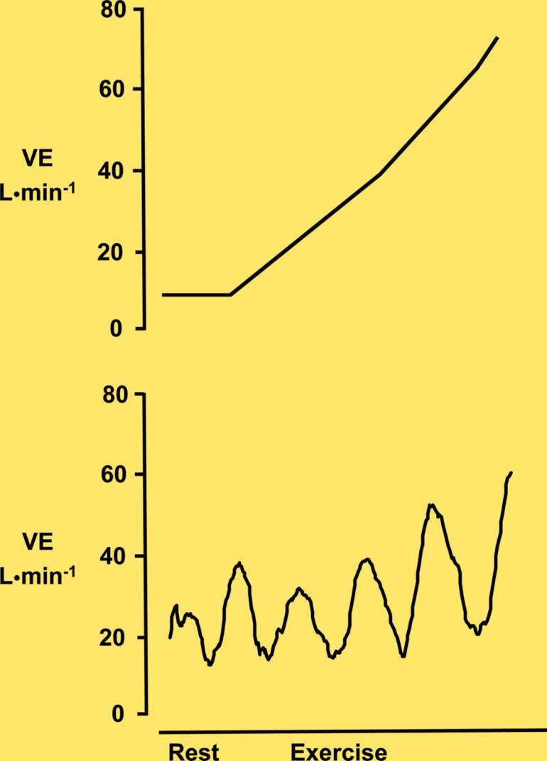Examples of normal ventilatory pattern (top panel) and exercise oscillatory ventilation pattern