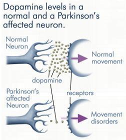 Parkinson s Syndrome: