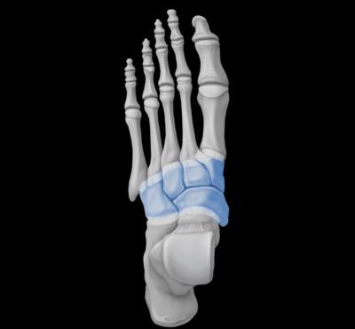 Osteoarthritis is often secondary to damage to the joint, for example as a result of previous fracture or injury, malalignment of the foot or infection.