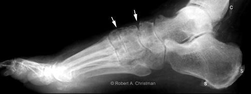 At left, this standing X-ray view of a right foot shows an abnormal gap between the first and second metatarsals (arrow). At right, this side X-ray view of the same foot shows loss of alignment.