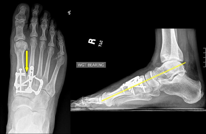 Post-surgery X-rays showing correction.