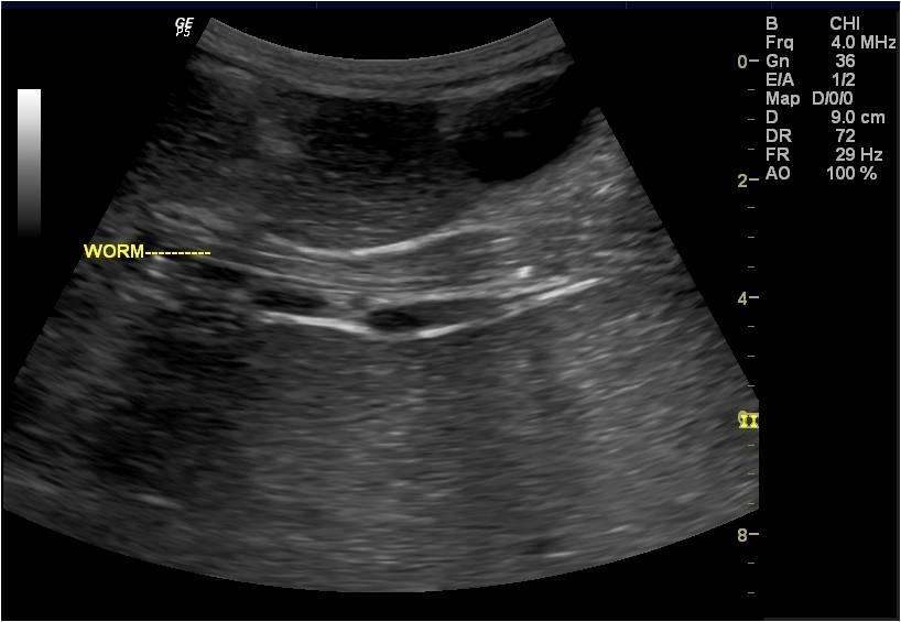 Figure 1 showing round worm in gall bladder Figure 2 showing round worm in common bile duct Figure 3 showing round worm in right lobe of liver.