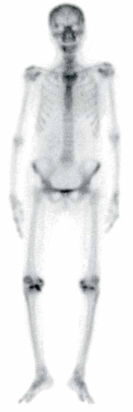 a b c d e Figure 2. a e. A 59-year-old female patient had therapy for carcinoma of the right breast. She presented with back pain. Bone scintigraphy was performed to rule out bone metastasis.