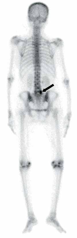 Axial SPECT (c) image shows uptake in the region of right facet joint of the L5-S1 vertebrae (arrow; score 5).