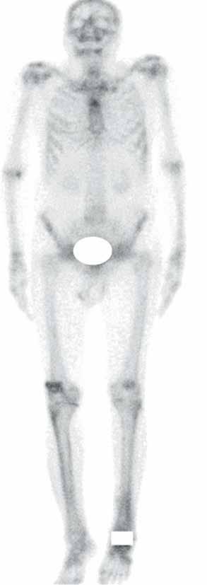 a b c d e Figure 4. a e. A 63-year-old male patient presented with multiple bone pain. Bone scintigraphy was performed to rule out bone metastasis.