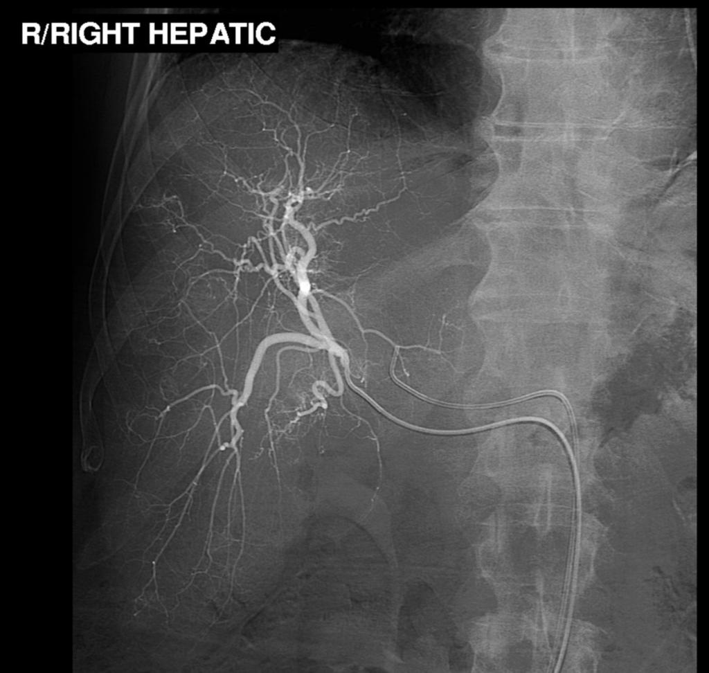 Fig. 4: Patient W.A. Right hepatic angiogram during pretreatment workup.