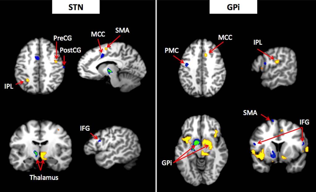 r Manes et al. r Contrast of connectivity maps generated from left and right hemisphere seeds. Regions shown in blue-green correspond to Left > Right contrasts (P > 0.