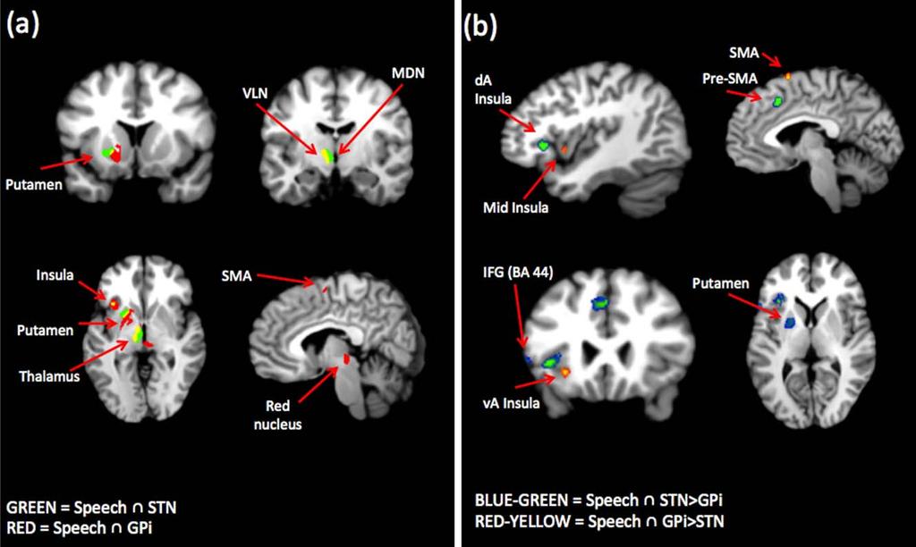 r Manes et al. r Figure 4. (a) Conjunction of STN and GPi MACMs to speech metaanalysis. Blue-green clusters correspond to Speech \ STN. Redyellow clusters correspond to Speech \ GPi.