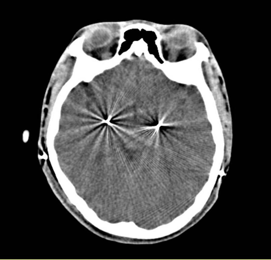 Jae Meen Lee, et al. Malignant Neuroleptic Syndrome following Deep Brain Stimulation 35 consisted of 300 mg/day levodopa, 2 mg/day diazepam, and 60 mg/day baclofen.