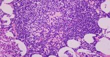 html Morphology Small, mature-appearing appearing lymphocytes Pale-staining proliferation centers in lymph nodes, bone marrow in some cases CLL/SLL Immunophenotype Pan B-cell antigens +, most dim