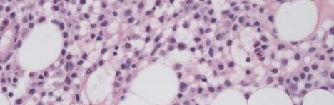 aplastic anemia HCL in bone marrow core biopsy HCL phenotype: