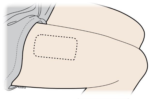 Do not touch the needle cover area. Do not place the loaded on-body infusor on your body if the red status light flashes continuously. Do not fold the skin adhesive over onto itself.