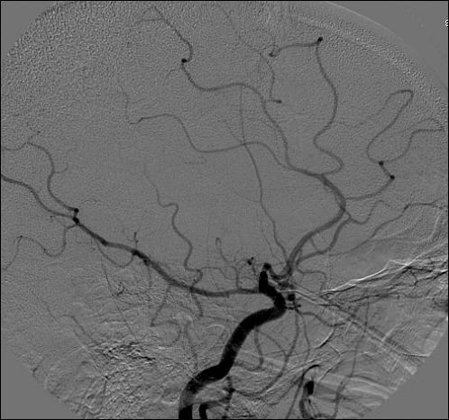 Angiography demonstrates left