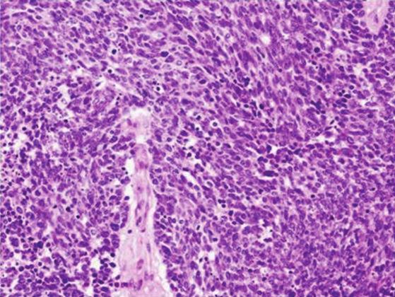 Caldwell-Luc antrostomy was performed. Pathologically, an infiltrative, proliferative tumor that had formed various large and small solid cancer nests was identified.