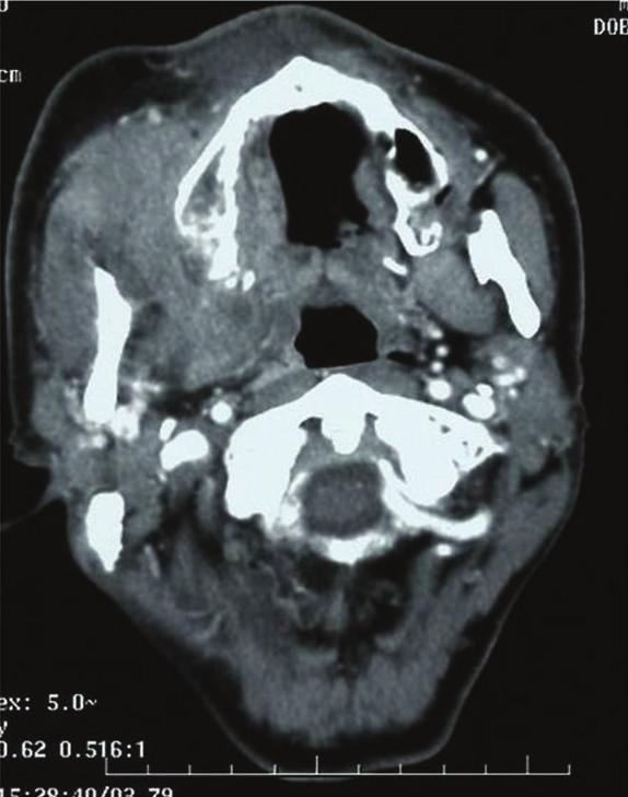 Figure5:Tumorcenteredontherightmaxillarysinusinfiltratedthe subcutis, right orbit, pterygopalatine fossa and ethmoid sinus. (Figure 6).