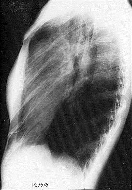 What abnormalities are shown in these chest X rays? 2.