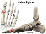 Introduction Hallux rigidus is a degenerative type of arthritis that affects the large joint at the base of the big toe.