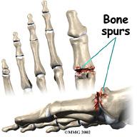 The condition may follow an injury to the joint or, in some cases, may arise without a well-defined injury.