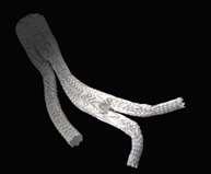 Sinusoidal pattern Provides nitinol stent support with