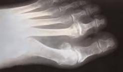 Hallux rigidus is a subset of bunion deformities. This is known as a dorsal bunion. The 1st metatarsal will elevate when it becomes unstable as opposed to abduct in the classic bunion.