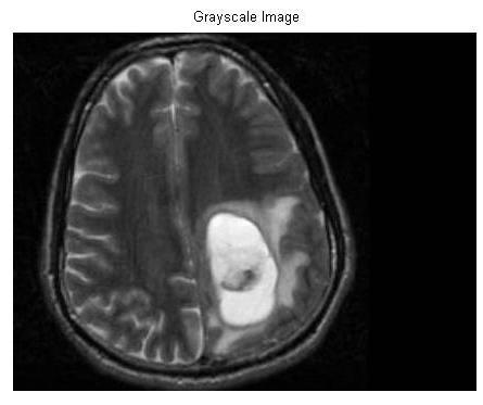 Fig 2 shows the original image from which the tumor has to be detected STEP II: RGB to gray conversion Fig 4.