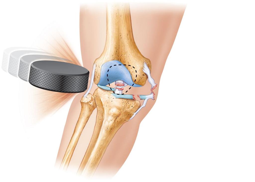 Figure 8.9 A common knee injury.