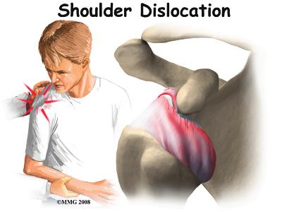 The specific type of dislocation is based on the position of the humeral head in relation to the glenoid (shoulder socket) at the time of the diagnosis.
