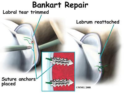 One of the most common procedures is the Bankart repair. During the Bankart reconstruction procedure, the labrum and capsule are reattached to the anterior margin of the glenoid cavity.