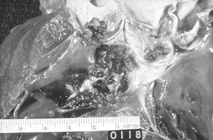 Infective Endocarditis Infective Endocarditis Historical Perspective.. A concretion larger than a pigeon s egg; contained in the left auricle.