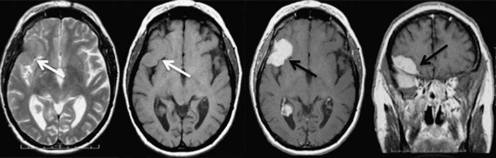 www.centauro.it NRJ Digital - The Neuroradiology Journal 2: 603-608, 2012 A B C D E F G H Figure 2 Right extra-axial sphenoidal lesion.