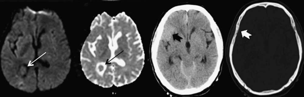 It was also isointense with brain tissue on DWI-w images (E) (thin white arrow), without significant diffusivity anomalies on ADC map (F) (thin black arrow).