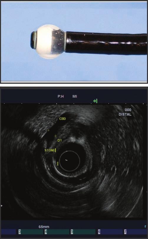 Yogananda Reddy and Robert P Willert Fig 3. Linear endoscopic ultrasound scope with fine needle aspiration (FNA) and pancreatic mass FNA. Fig 2.