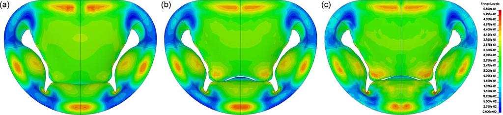 1060 K.D. Lau et al. / Medical Engineering & Physics 32 (2010) 1057 1064 2.3.2. Fluid structure simulation In the FSI simulations, the transvalvular pressure was applied to the boundaries of the fluid models (see Fig.