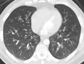 cough, myalgias Image of Multifocal Pneumonia Diffuse GGO Diffuse consolidation i Not