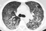 Patterns of community acquired viral infection No Imaging findings/ Normal exam Imaging insensitive for viral LTRI Bronchitis/bronchiolitis Bronchial