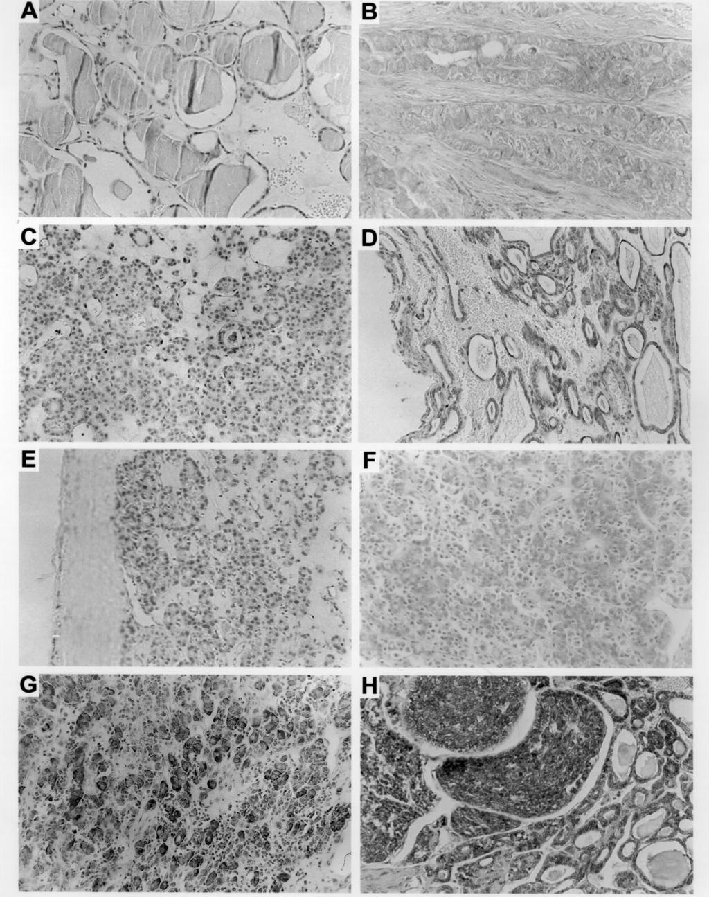 ONCOLOGY REPORTS 12: 239-243, 2004 241 Figure 1. Immunohistochemical analysis of TB10 in thyroid tissues.