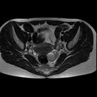 Marked hyperintense signal observed in the left ovary and a weakly hyperintense thin area is observed in the posterior uterine wall, referred to as an endometril implant.