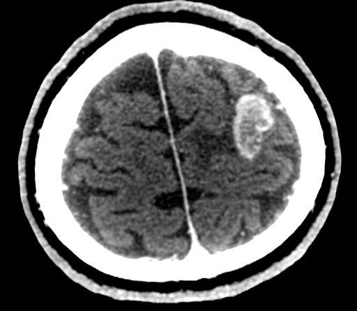 a b CT image of a metastatic