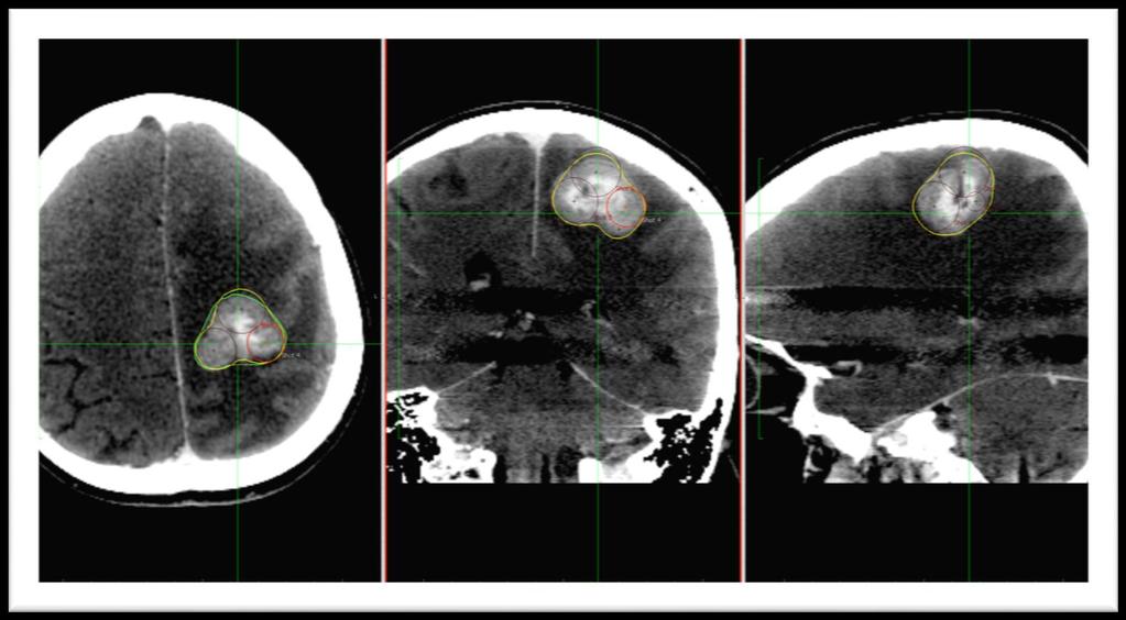 Failure 45 yrs old female was treated with a soliter metastatic lesion (21Gy@50%) in