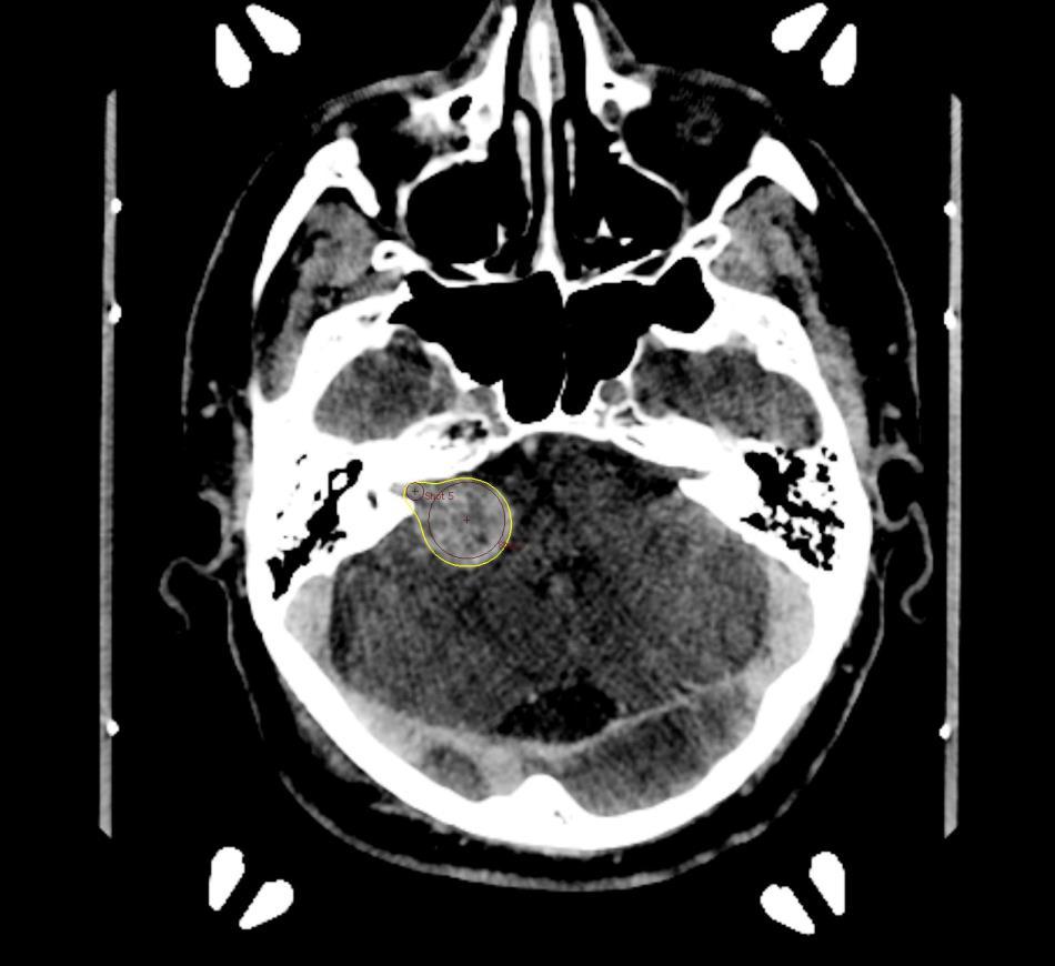 a a b Tipical vestibular schwannoma is observable at the time of treatment on