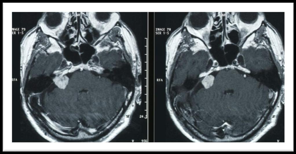 Case I On the one year control MR images, the tumor size