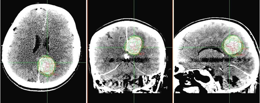 CT images of a parasagital